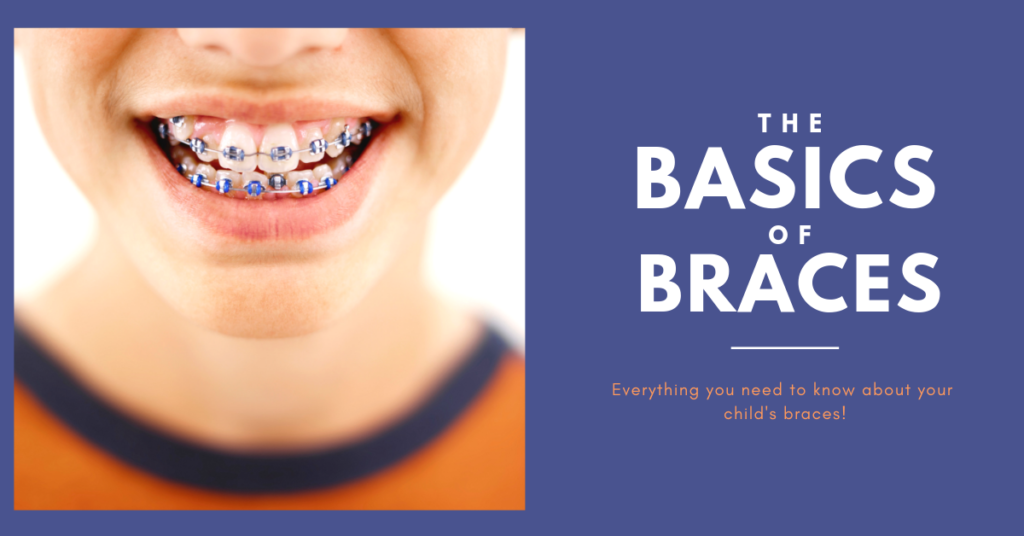 The Basics Of Braces - How Do I Know If My Child Needs Braces ...